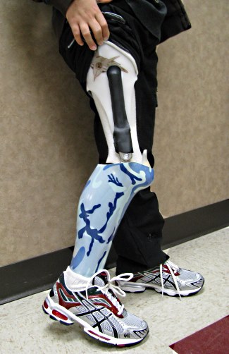 Ethan Earl's rotationplasty prosthesis