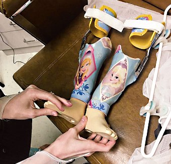 Stella's laminated prostheses